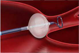 カテーテルのイラスト